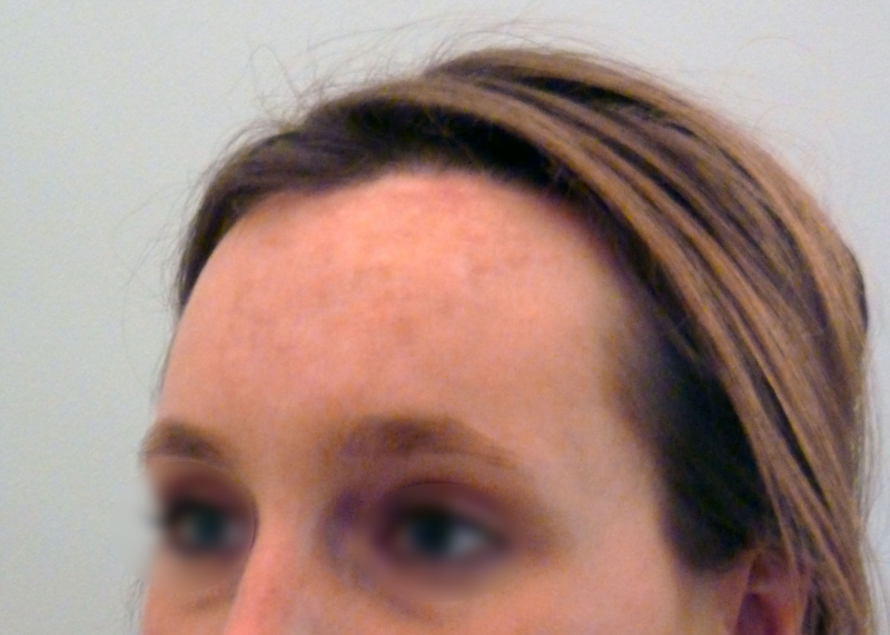 Abaissement De La Ligne Capillaire Lowering Hairline Or Advancement